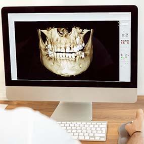 Computer screen showing guided dental implant surgery in Lexington