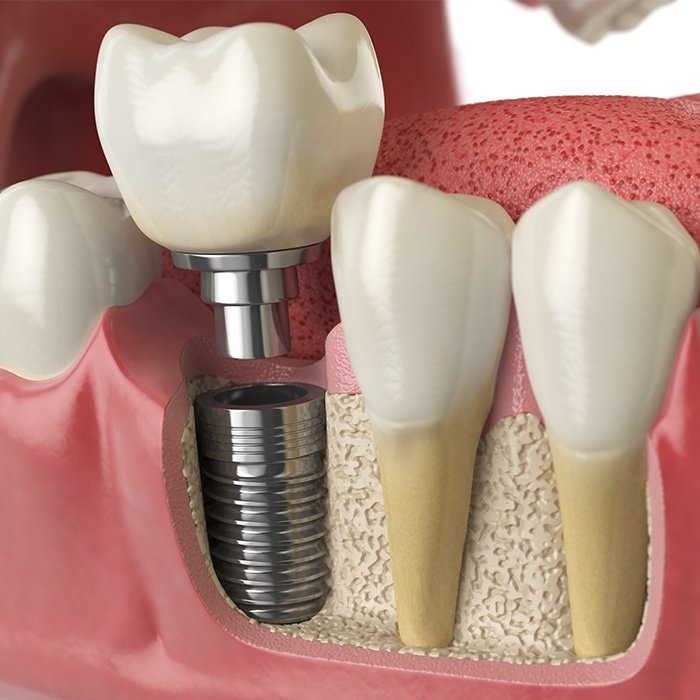 Animation of dental implant process
