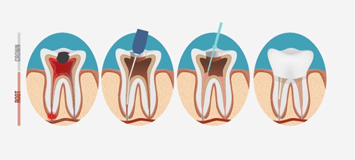 Diagram of a root canal treatment