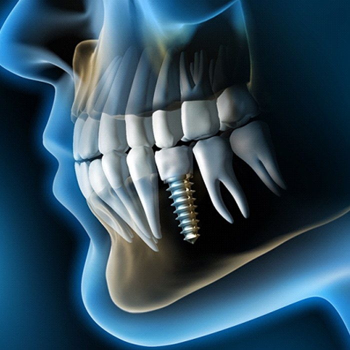 Dental Implant Bone Graft Lexington Dental Wellness Of Lexington Dental Implant Bone Graft Lexington Dental Wellness Of Lexington