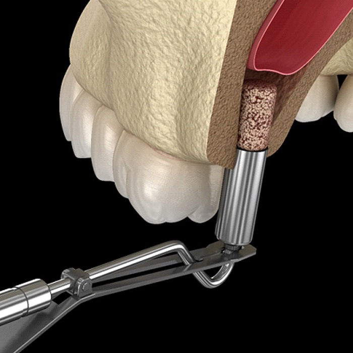 computer model of a sinus being lefted