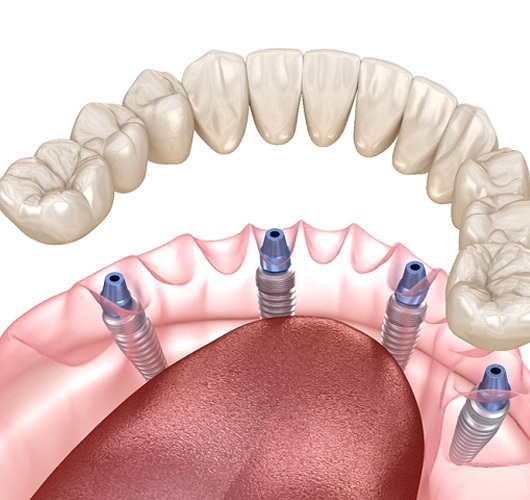 Illustration of All-On-4