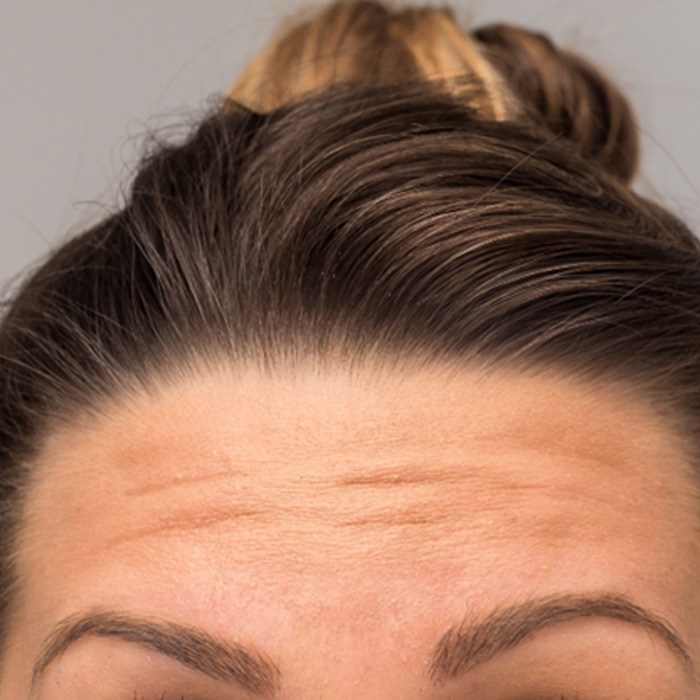 a closeup of a person’s forehead lines