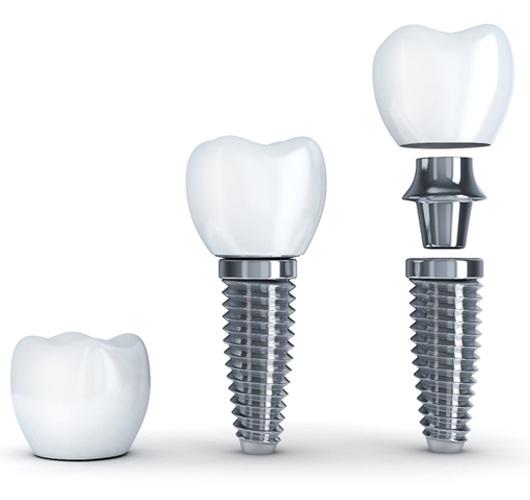dental implants