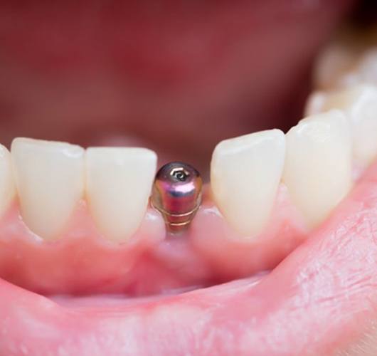 dental implant