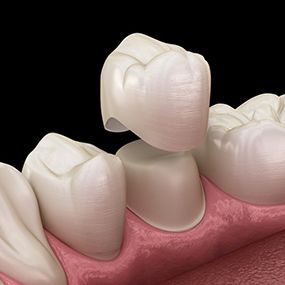 diagram of dental crown being placed over bottom molar