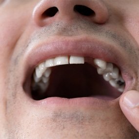 man pointing to missing tooth