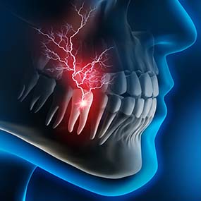 X-ray diagram of a toothache in Lexington