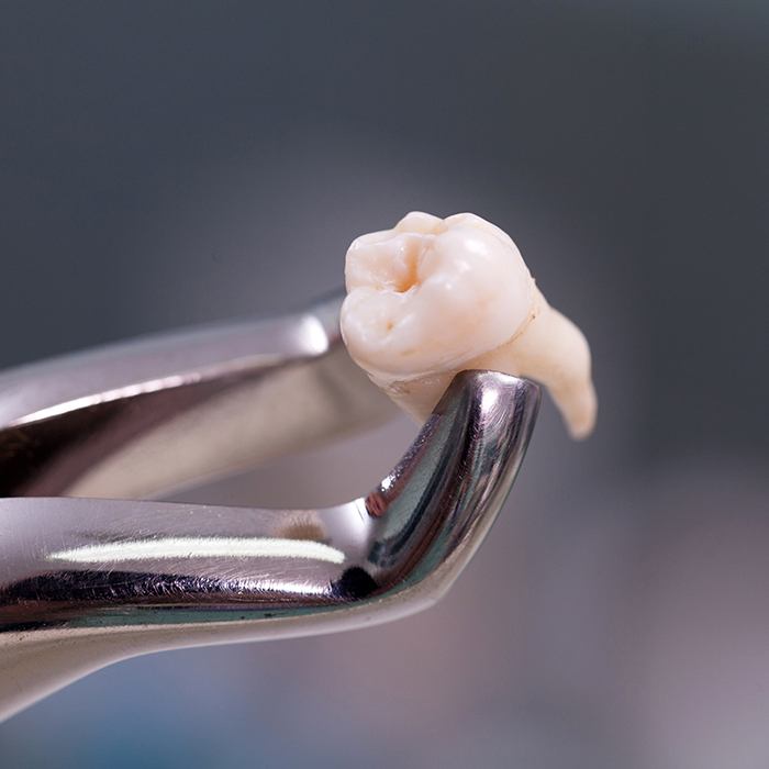 Metal clasp holding extracted tooth