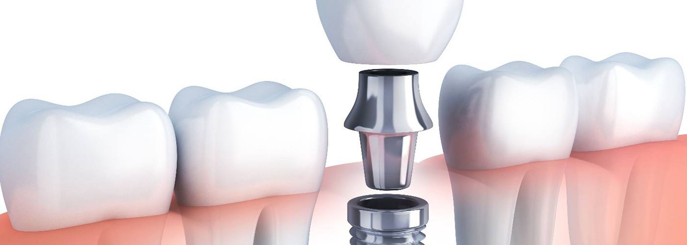diagram of implant crown in Lexington