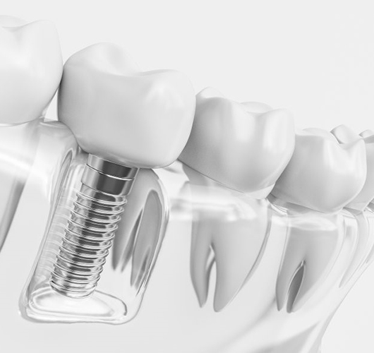 diagram of dental implant