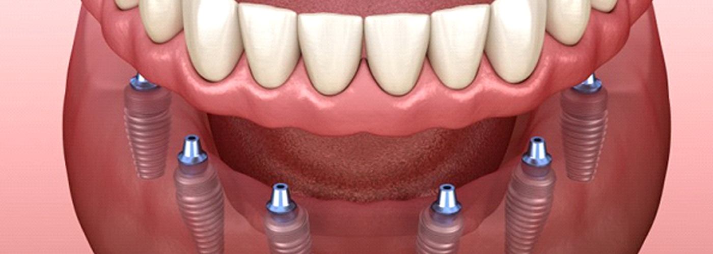 model of implant dentures in Lexington