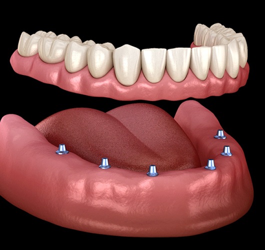 implant denture supported by six dental implants in Lexington