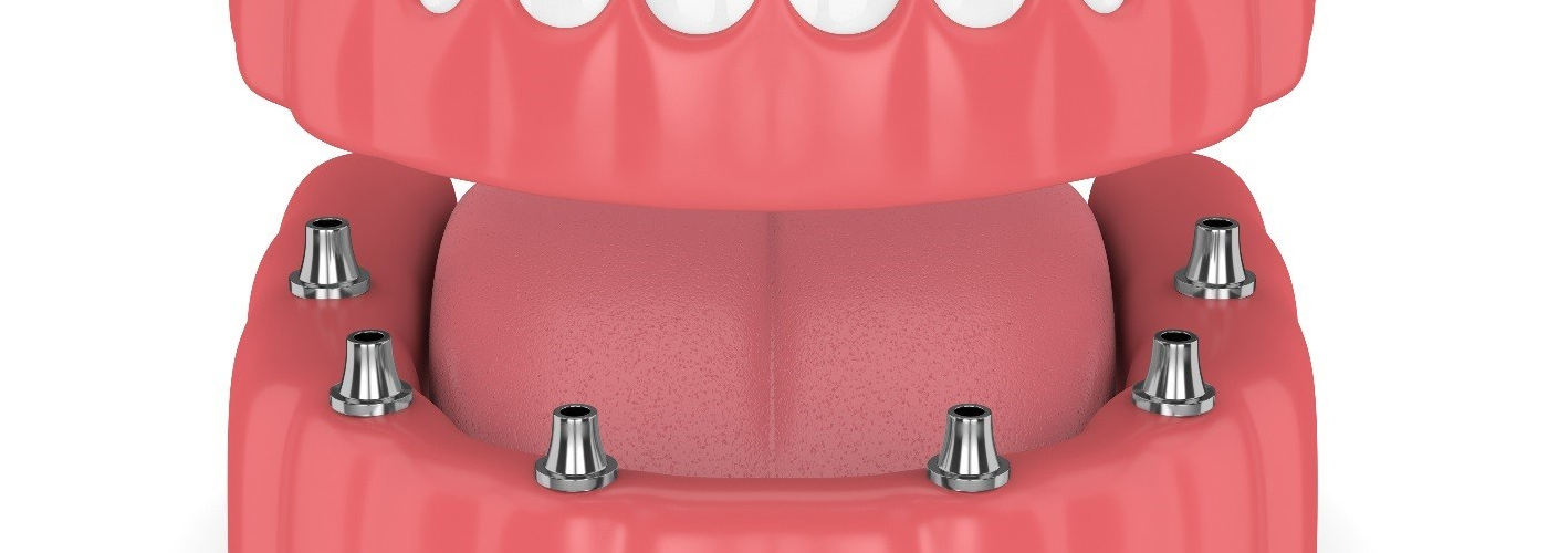 model of implant-retained denture