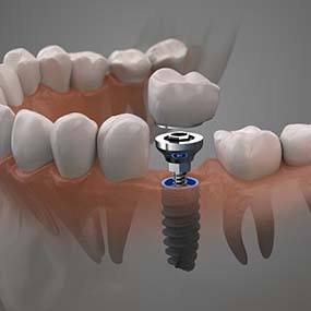 Illustration of a single tooth dental implant in Lexington