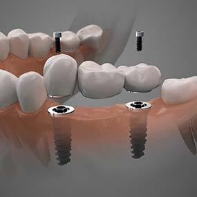 Illustration of implant bridge replacing multiple missing teeth in Lexington