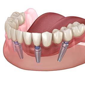 Diagram of All-On-4 dental implants in Lexington