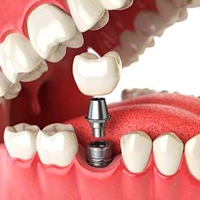 Diagram of dental implant placement in Lexington