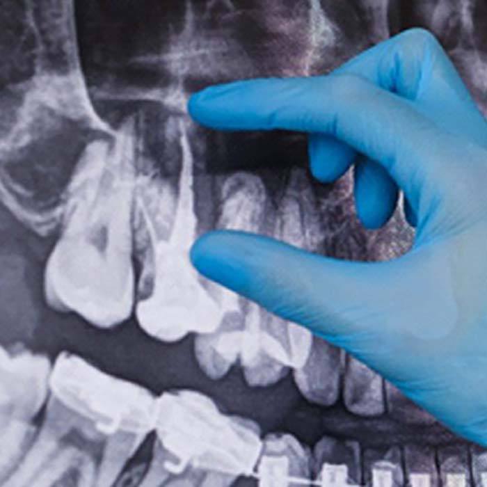 Lexington implant specialist measuring dental X-ray