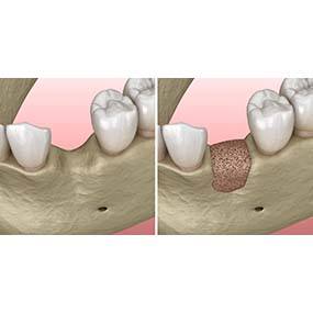 Before and after bone grafting for dental implants in Lexington