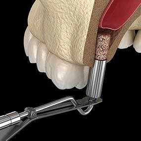 Digital illustration of a sinus lift for dental implants in Lexington