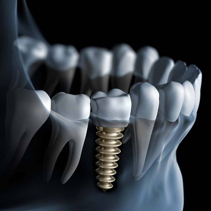 X-ray diagram of a dental implant in Lexington after placement