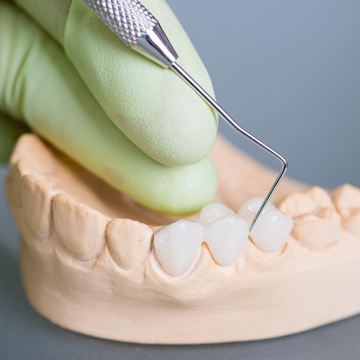 Model smile with dental restorations