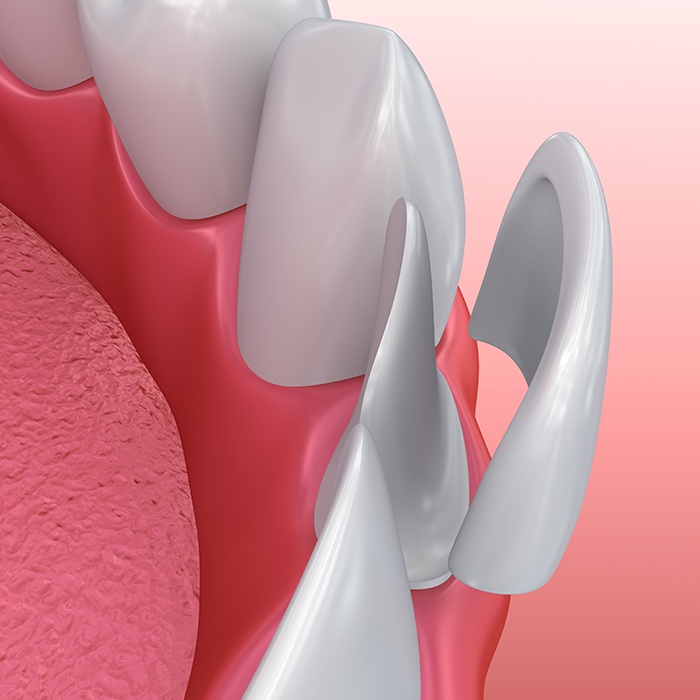 Animation of porcelain veneer placement