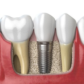 an illustration of osseointegration and dental implant abutments