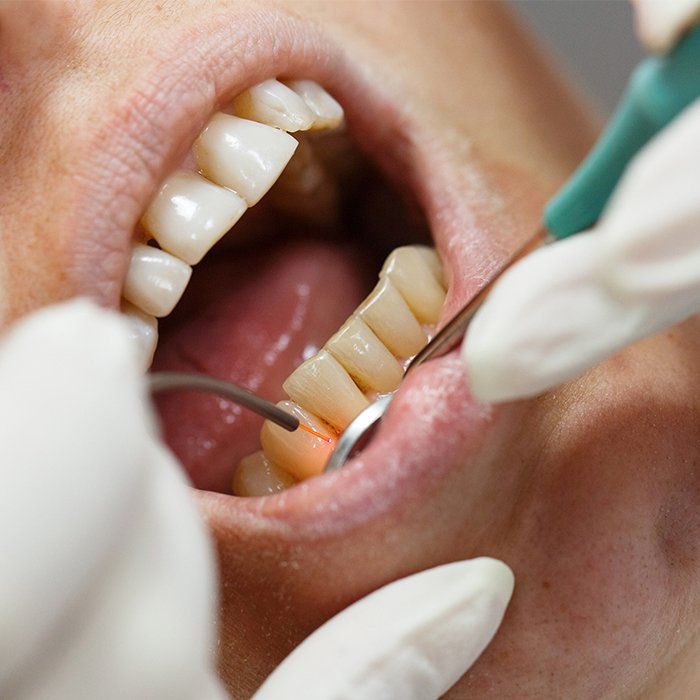 Closeup of patient receiving soft tissue laser treatment