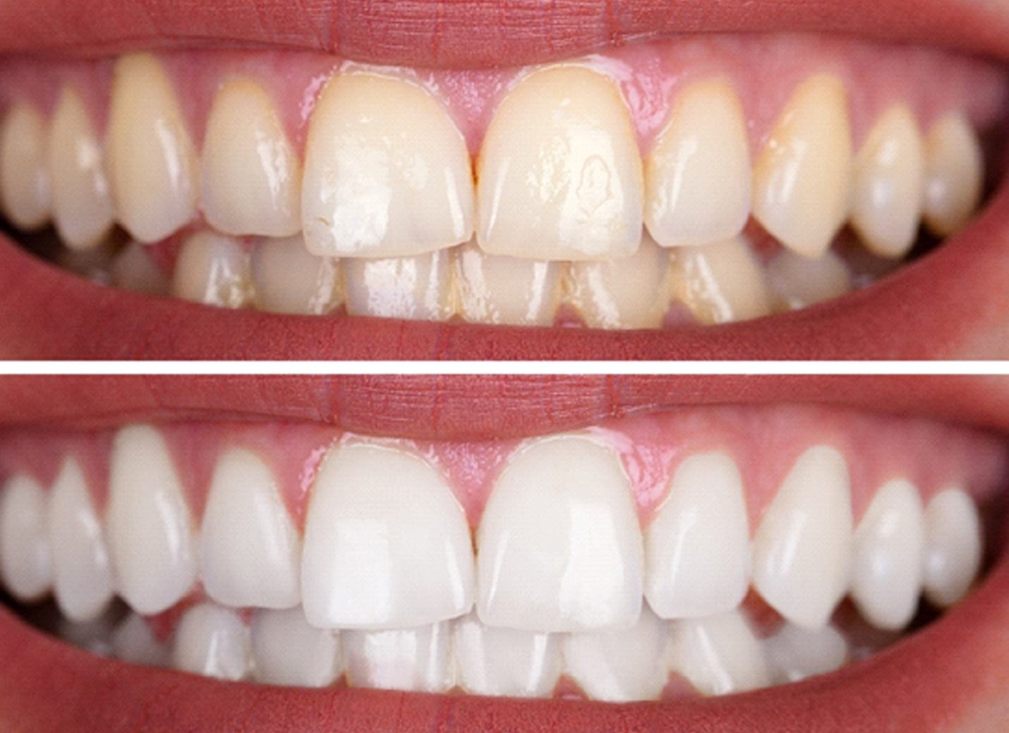 before and after teeth whitening results