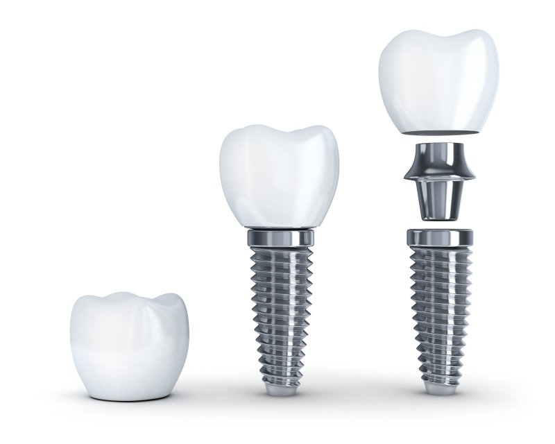 a single tooth dental implant in Lexington and all its parts