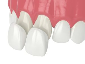 veneers 3D illustration 