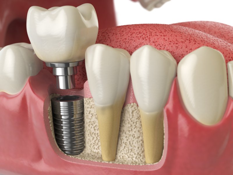 3-D Diagram of a dental implant