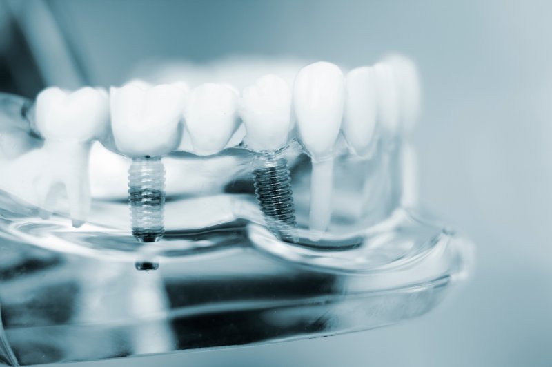A model of dental implants