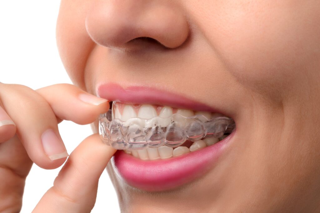 Nose-to-chin 3/4 profile closeup of woman inserting Invisalign over upper arch