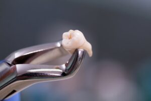 Close-up on extracted tooth being held by dental instrument.