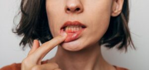 Woman showing red, inflamed gums. 